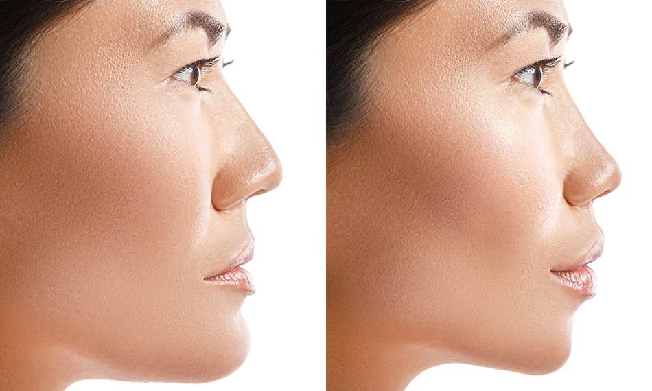 Rhinoplasty (Nose Surgery)